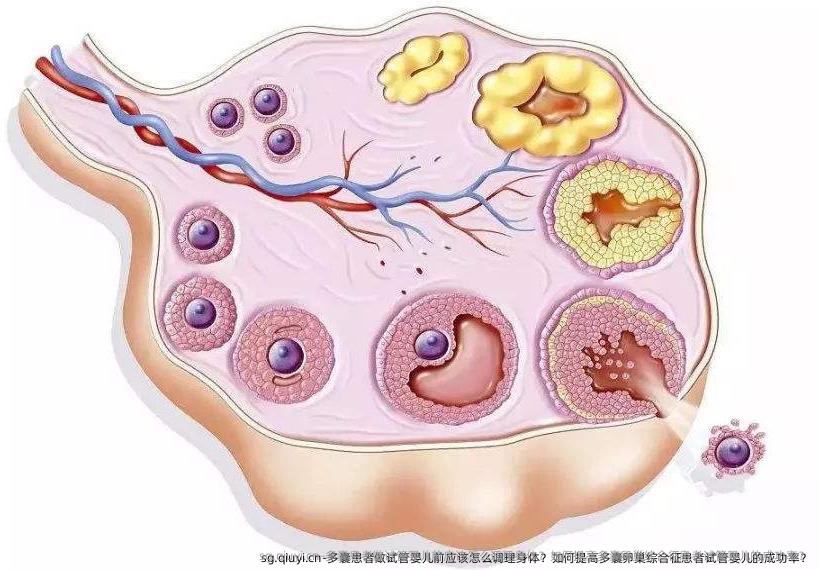 多囊患者做试管婴儿前应该怎么调理身体？如何提高多囊卵巢综合征患者试管婴儿的成功率？