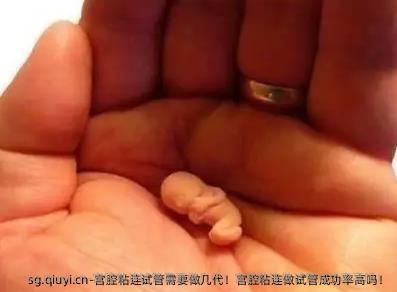 宫腔粘连试管需要做几代！宫腔粘连做试管成功率高吗！