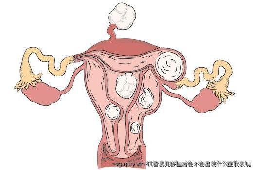 试管婴儿移植后会不会出现什么症状表现