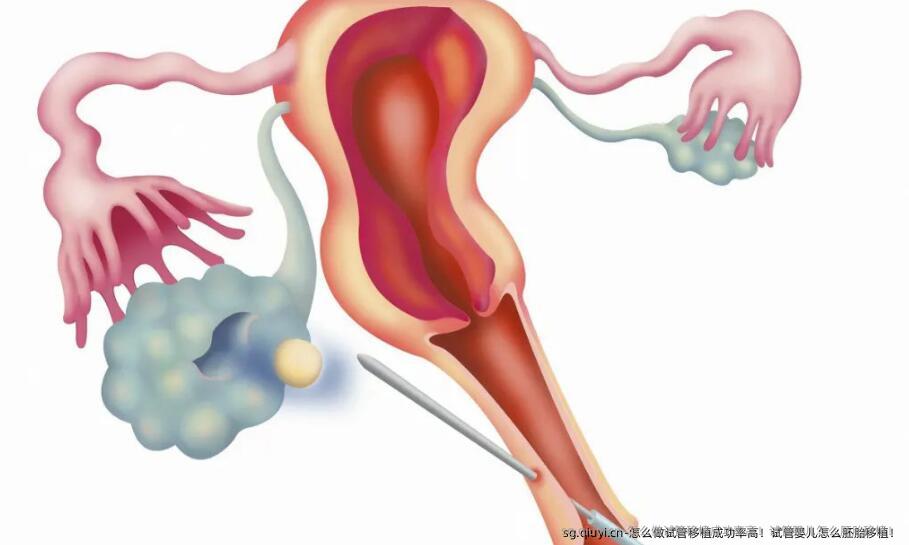 怎么做试管移植成功率高！试管婴儿怎么胚胎移植！