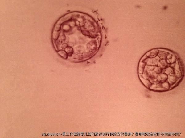 第三代试管婴儿如何通过医疗保险支付费用？费用根据宝宝的不同而不同？