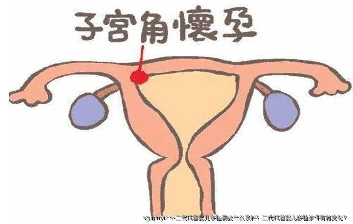 三代试管婴儿移植需要什么条件？三代试管婴儿移植条件有何变化？