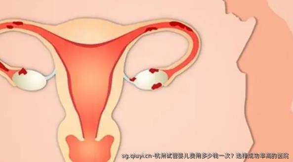 杭州试管婴儿费用多少钱一次？选择成功率高的医院