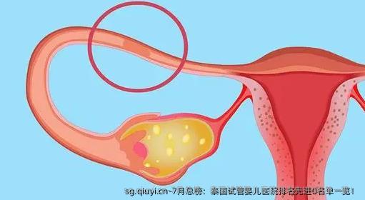 7月总榜：泰国试管婴儿医院排名先进0名单一览！