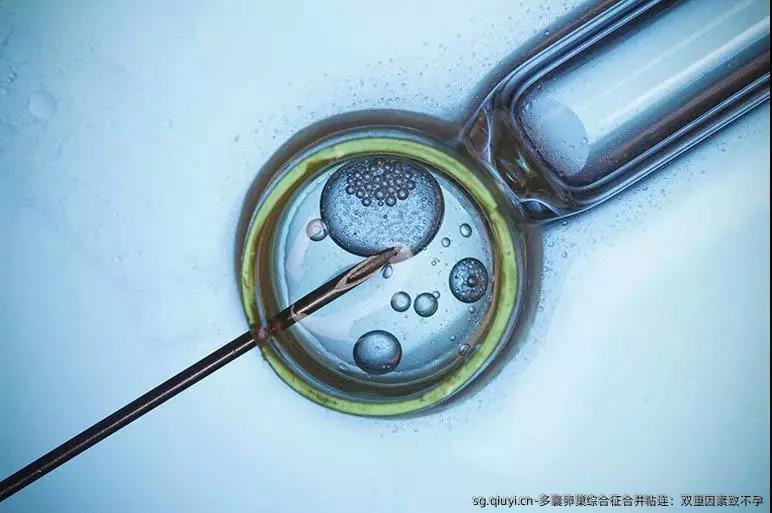 多囊卵巢综合征合并粘连：双重因素致不孕