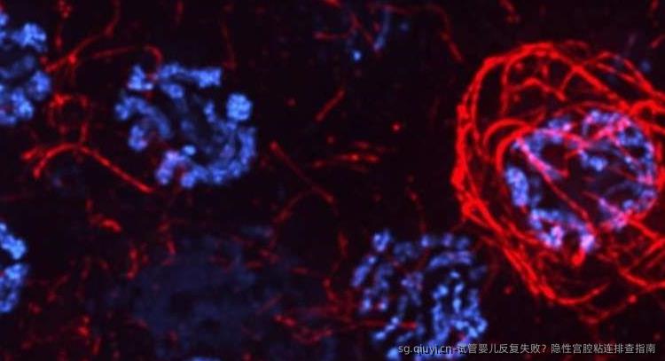 试管婴儿反复失败？隐性宫腔粘连排查指南