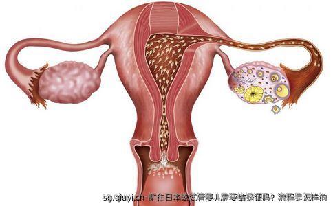 前往日本做试管婴儿需要结婚证吗？流程是怎样的