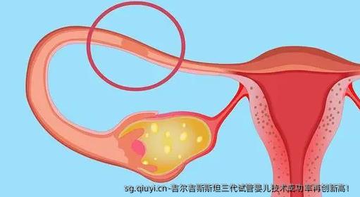 吉尔吉斯斯坦三代试管婴儿技术成功率再创新高！
