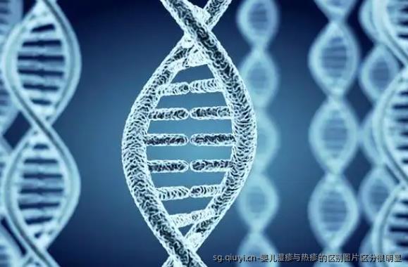 婴儿湿疹与热疹的区别图片区分很明显