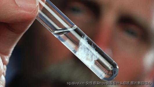 女性感染hpv病毒有什么症状 图片触目惊心