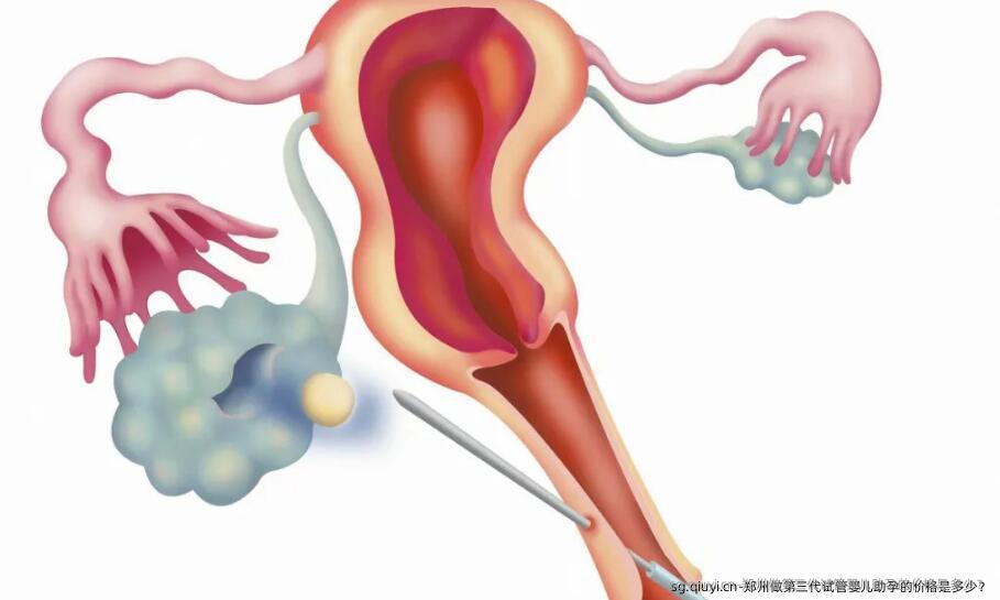 郑州做第三代试管婴儿助孕的价格是多少？