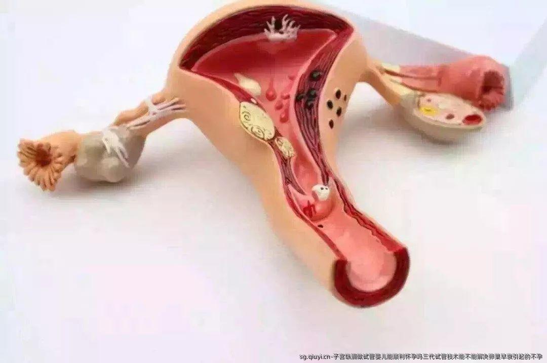 子宫纵膈做试管婴儿能顺利怀孕吗三代试管技术能不能解决卵巢早衰引起的不孕