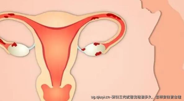 深圳三代试管流程要多久，怎样安排更合理
